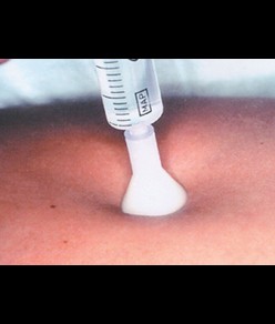 S.I.T. terapia a iniezione cutanea