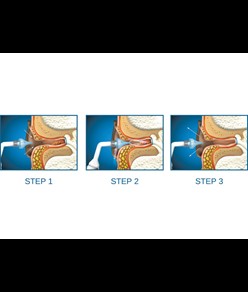 Sistema di irrigazione Otoclear