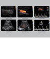Colordoppler Chison ECO5 Colordoppler Chison ECO5