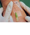 medicazioni Tegaderm medicazioni Tegaderm