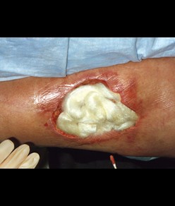 medicazioni Tegaderm Alginate