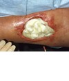 medicazioni Tegaderm Alginate medicazioni Tegaderm Alginate