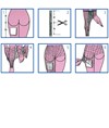 Rete tubolare per corpo/pelvi/coscia Zerolatex Surgifix Rete tubolare per corpo/pelvi/coscia Zerolatex Surgifix