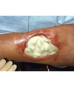 medicazioni Tegaderm Alginate