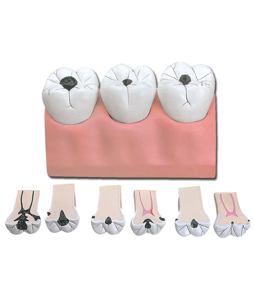 Modello carie dimensioni 4 a 1 con 3 denti, 12 x 6 x h 6 cm