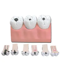 Modello carie dimensioni 4 a 1 con 3 denti
