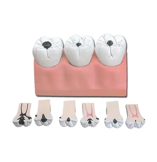 Modello carie dimensioni 4 a 1 con 3 denti