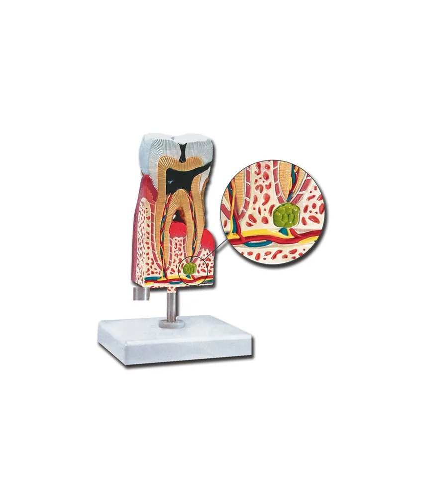 Modello molare inferiore con carie, 11 x 11 x h 19,5 cm