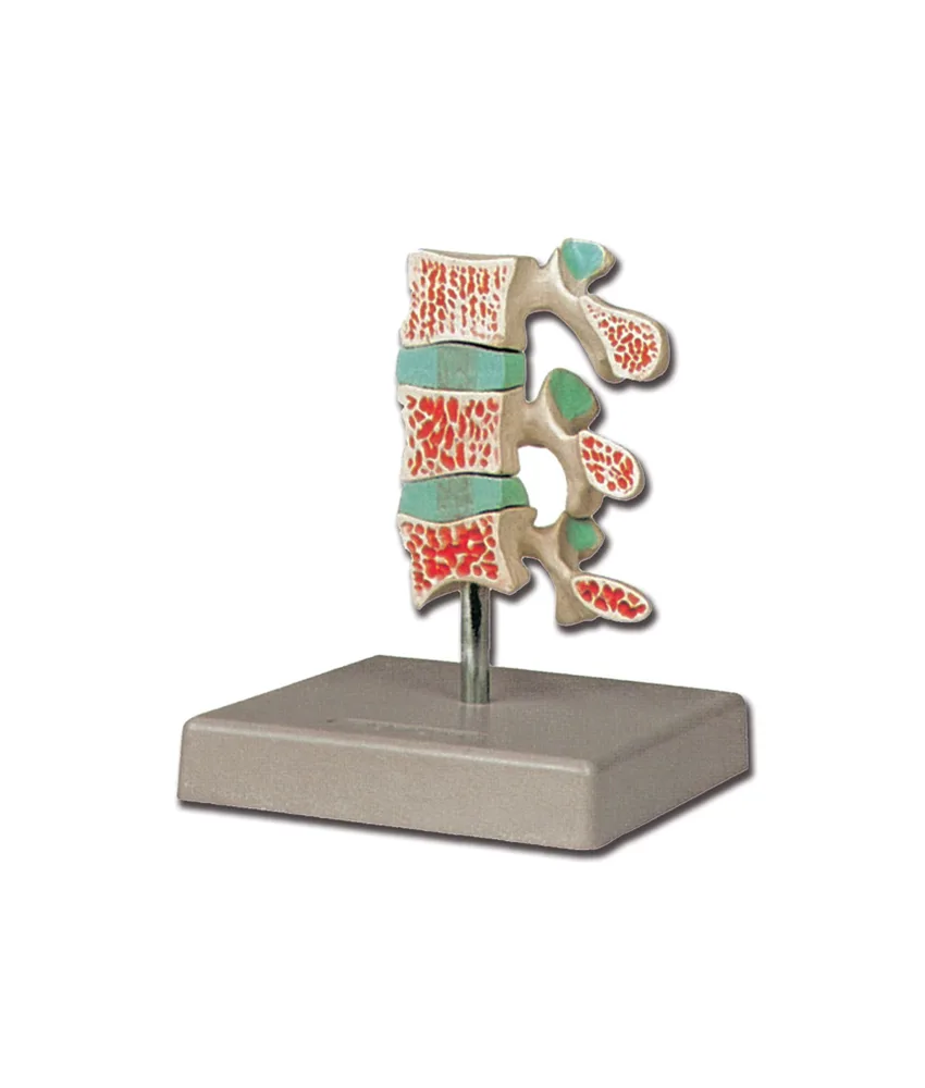 Modello osteoporosi avanzata, 12 x 12 x h 15 cm