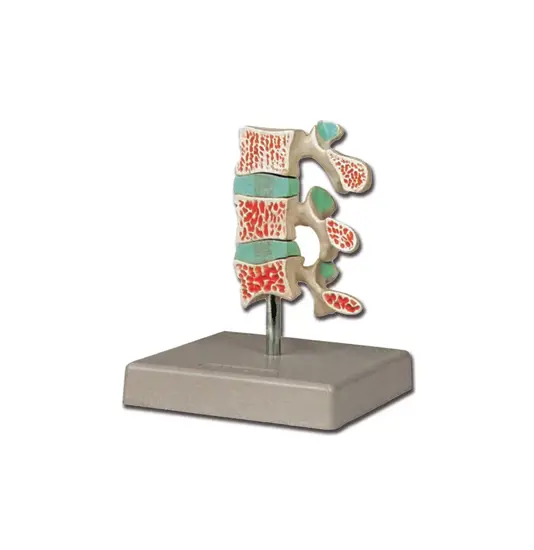 Modello osteoporosi avanzata
