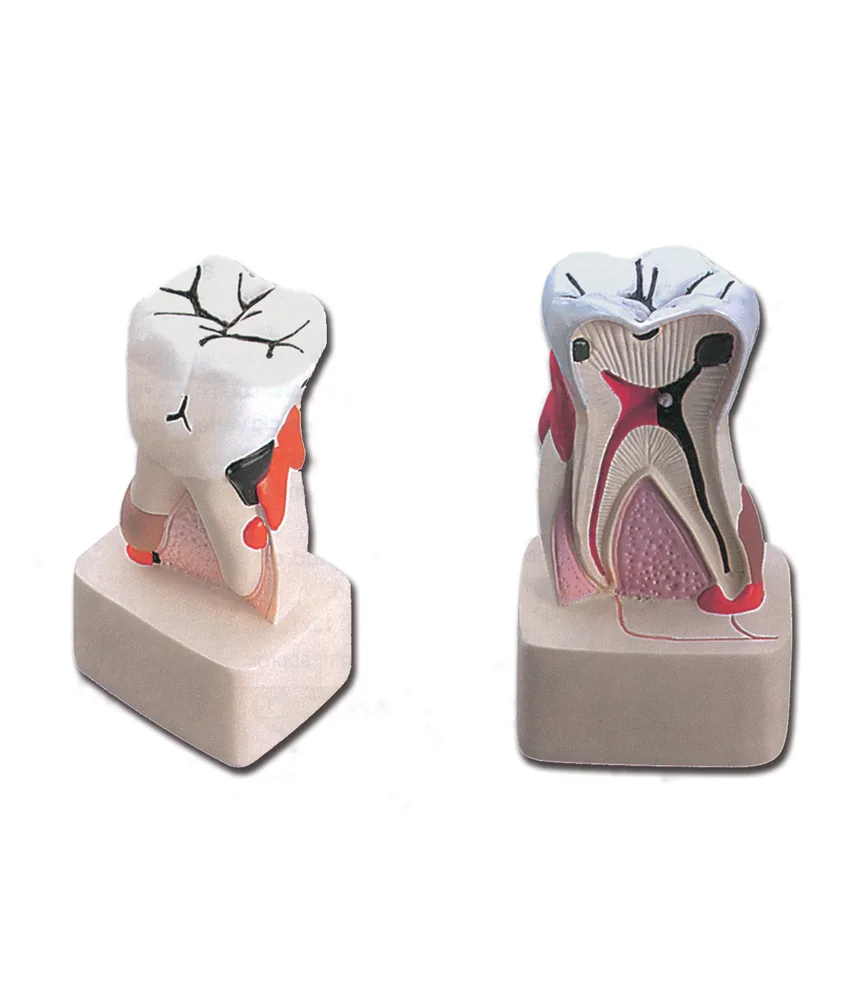 Modello patologia dentale, 6 x 4,5 x h 11 cm