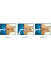 Sistema di irrigazione Otoclear